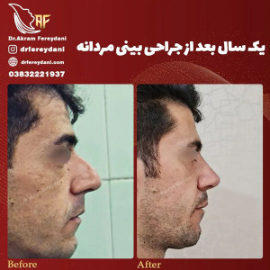 جراحی-بینی-148
