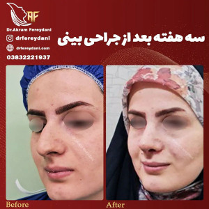 جراحی-بینی-149