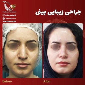 جراحی-بینی-15