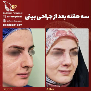 جراحی-بینی-150