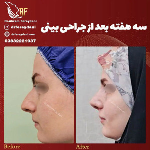 جراحی-بینی-151
