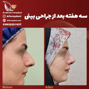 جراحی-بینی-152