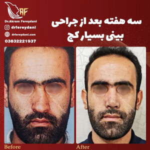 جراحی-بینی-153