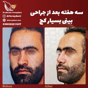 جراحی-بینی-154