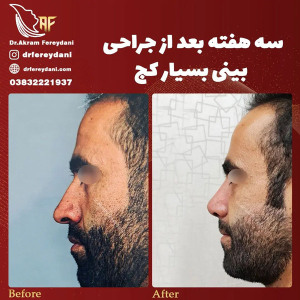 جراحی-بینی-155