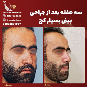 جراحی-بینی-156