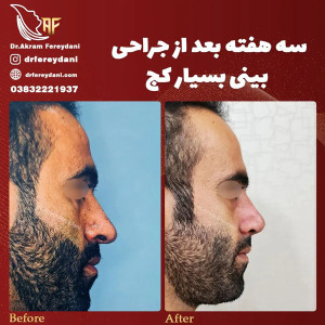 جراحی-بینی-157