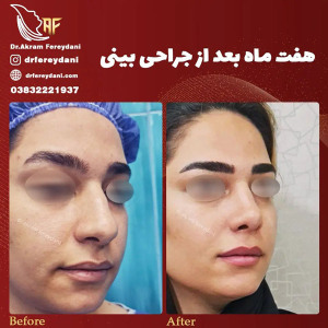 جراحی-بینی-158