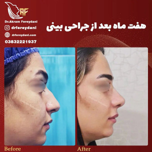 جراحی-بینی-159