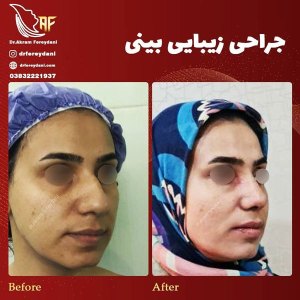جراحی-بینی-16