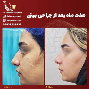 جراحی-بینی-160