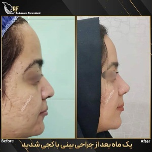 جراحی-بینی-161