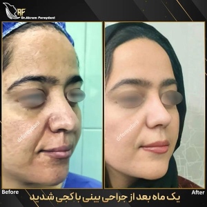 جراحی-بینی-162