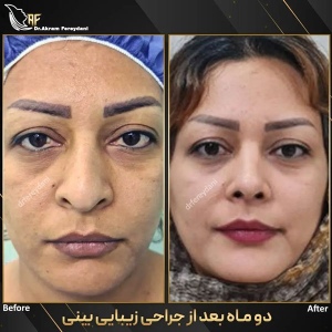 جراحی-بینی-163