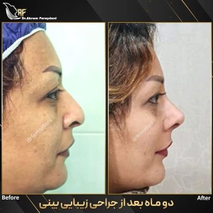 جراحی-بینی-164
