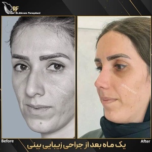 جراحی-بینی-165