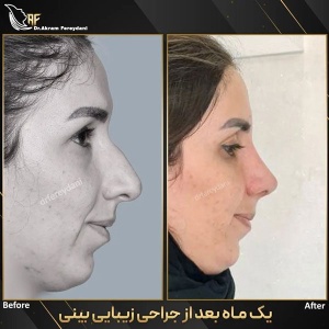 جراحی-بینی-166