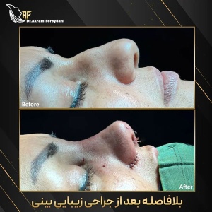 جراحی-بینی-167