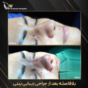 جراحی-بینی-168