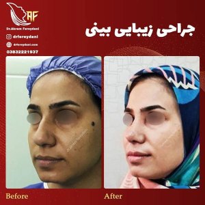 جراحی-بینی-17