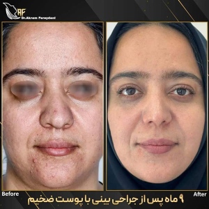 جراحی-بینی-171