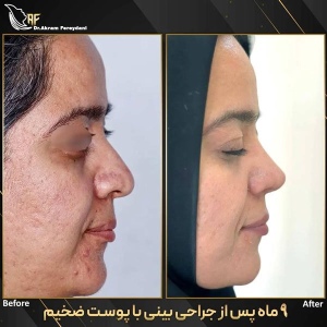 جراحی-بینی-172