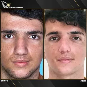 جراحی-بینی-173