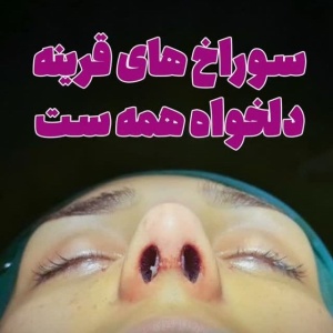 جراحی-بینی-178