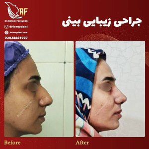 جراحی-بینی-18