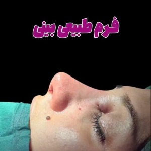 جراحی-بینی-181