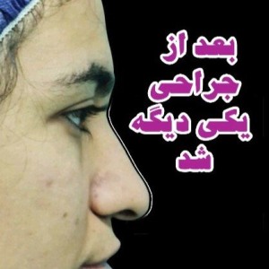 جراحی-بینی-182