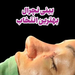 جراحی-بینی-183