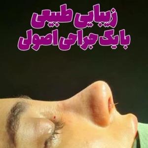 جراحی-بینی-184