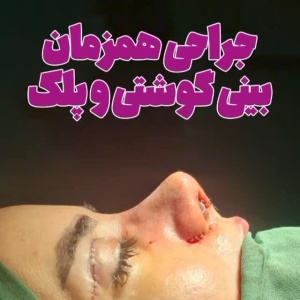 جراحی-بینی-185