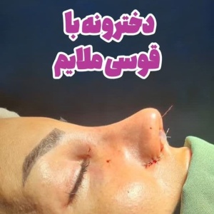 جراحی-بینی-188