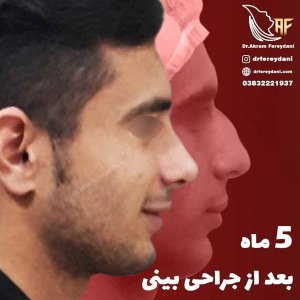 جراحی-بینی-2