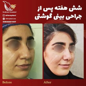 جراحی-بینی-20