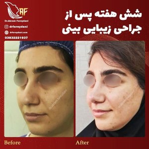 جراحی-بینی-22