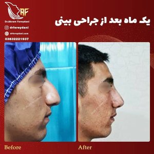 جراحی-بینی-27