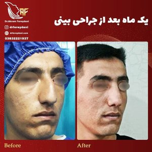 جراحی-بینی-28