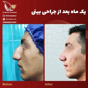 جراحی-بینی-29
