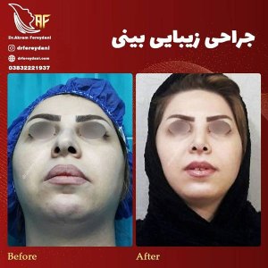 جراحی-بینی-3