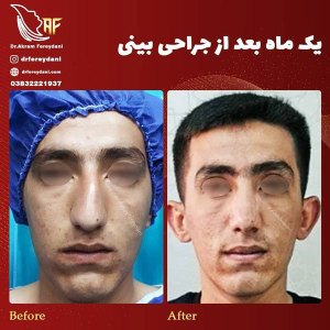 جراحی-بینی-30