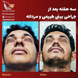 جراحی-بینی-31