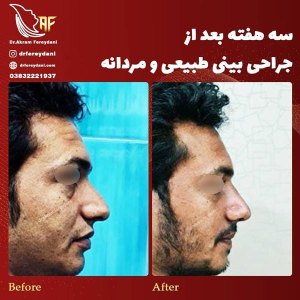 جراحی-بینی-32