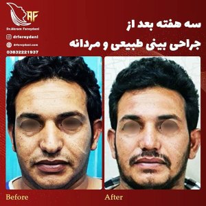 جراحی-بینی-33