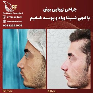 جراحی-بینی-34