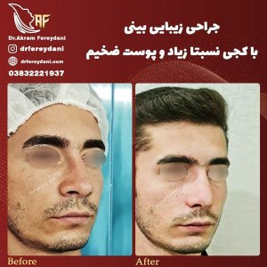 جراحی-بینی-35