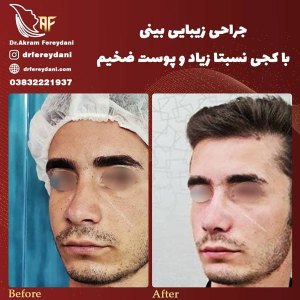 جراحی-بینی-36