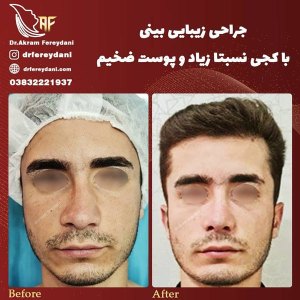 جراحی-بینی-37